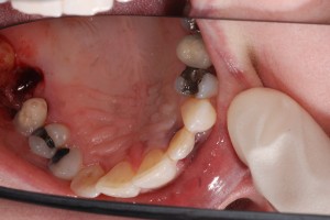 Broken fillings , bleeding gums causes bad breath