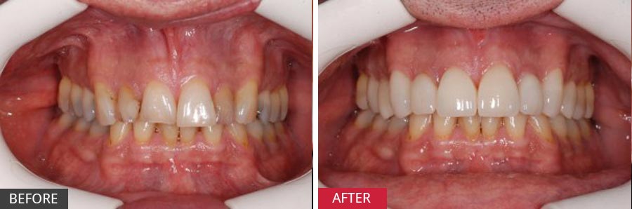 tooth veneers before and after