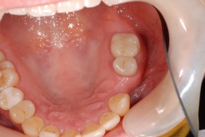 All-teeth-tidied-up-BEFORE-implant-placement-300×200