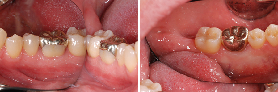 Gold-crowns-or-overlays-are-the-most-durable-of-all-restorations-22