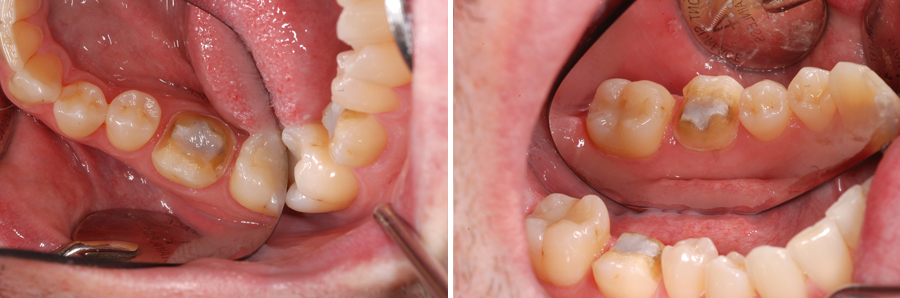 Gold-crowns-or-overlays-are-the-most-durable-of-all-restorations
