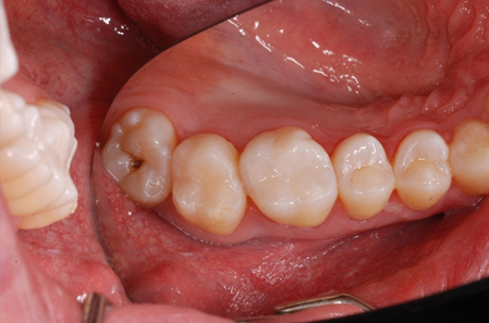 Leaking-amalgam-fillings-–-Why-fix-what’s-not-busted-2