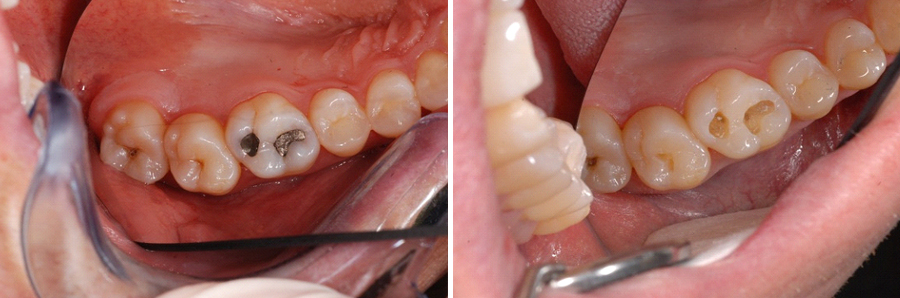 Leaking-amalgam-fillings-–-Why-fix-what’s-not-busted