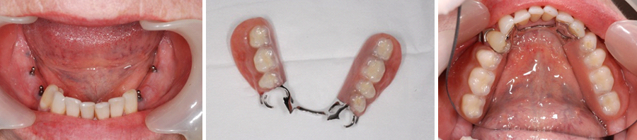 Mini-Implants-to-support-a-Lower-Partial-denture