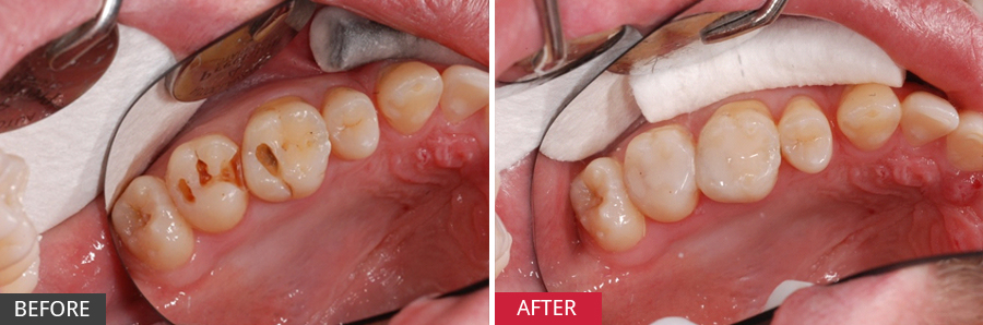 Multiple-cavities-in-adjacent-teeth
