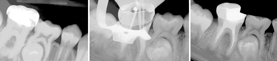 Root-Canal-treatment-in-a-9-year-old
