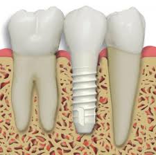 dental implants - zirconia implant