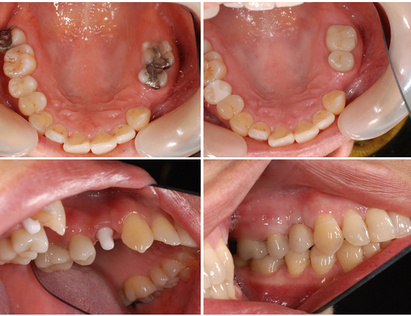 missing-side-tooth11 - Caring 4 Smiles