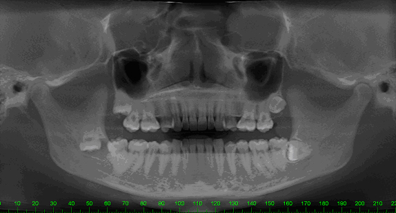 wisdom-teeth-caring4smiles