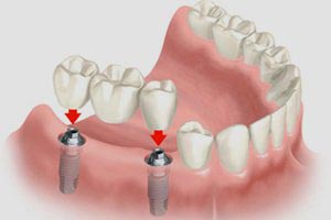 dental implants auckland