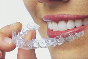 invisalign braces