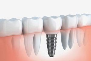 Tooth replacement with dental implants