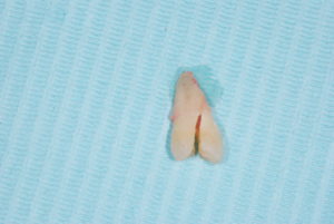 cracked tooth side