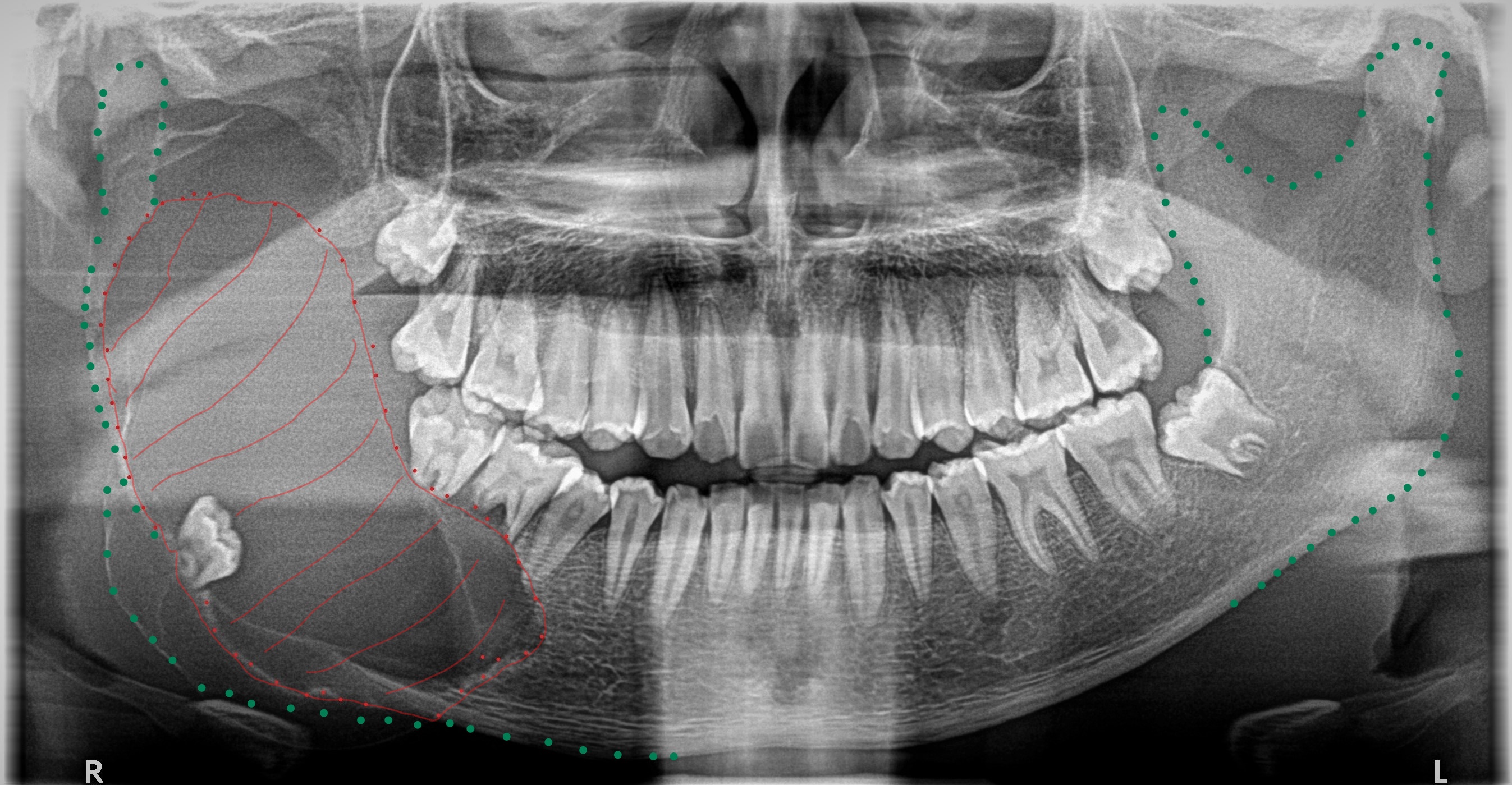 Wisdom teeth 14-year-old