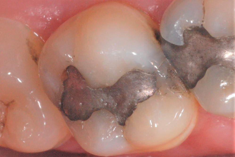 Cracked molar 2