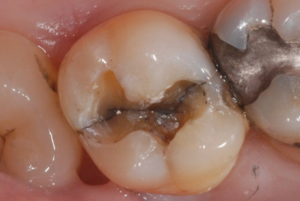 Cracked molar