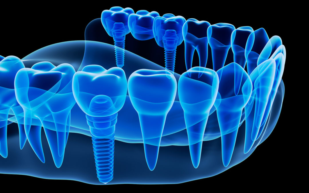 X-ray view of denture with implant , 3D illustration.