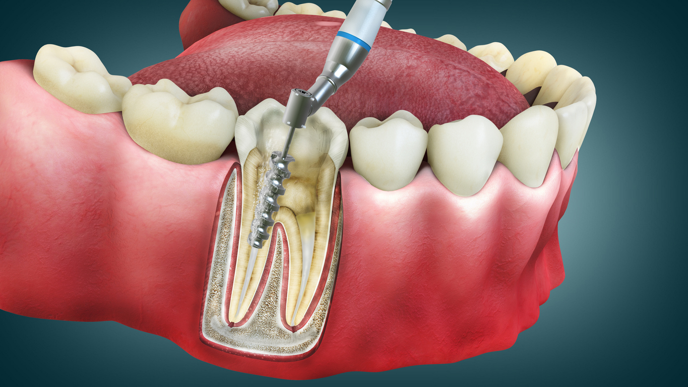 How Much Does A Root Canal Cost in Auckland Caring 4 Smiles